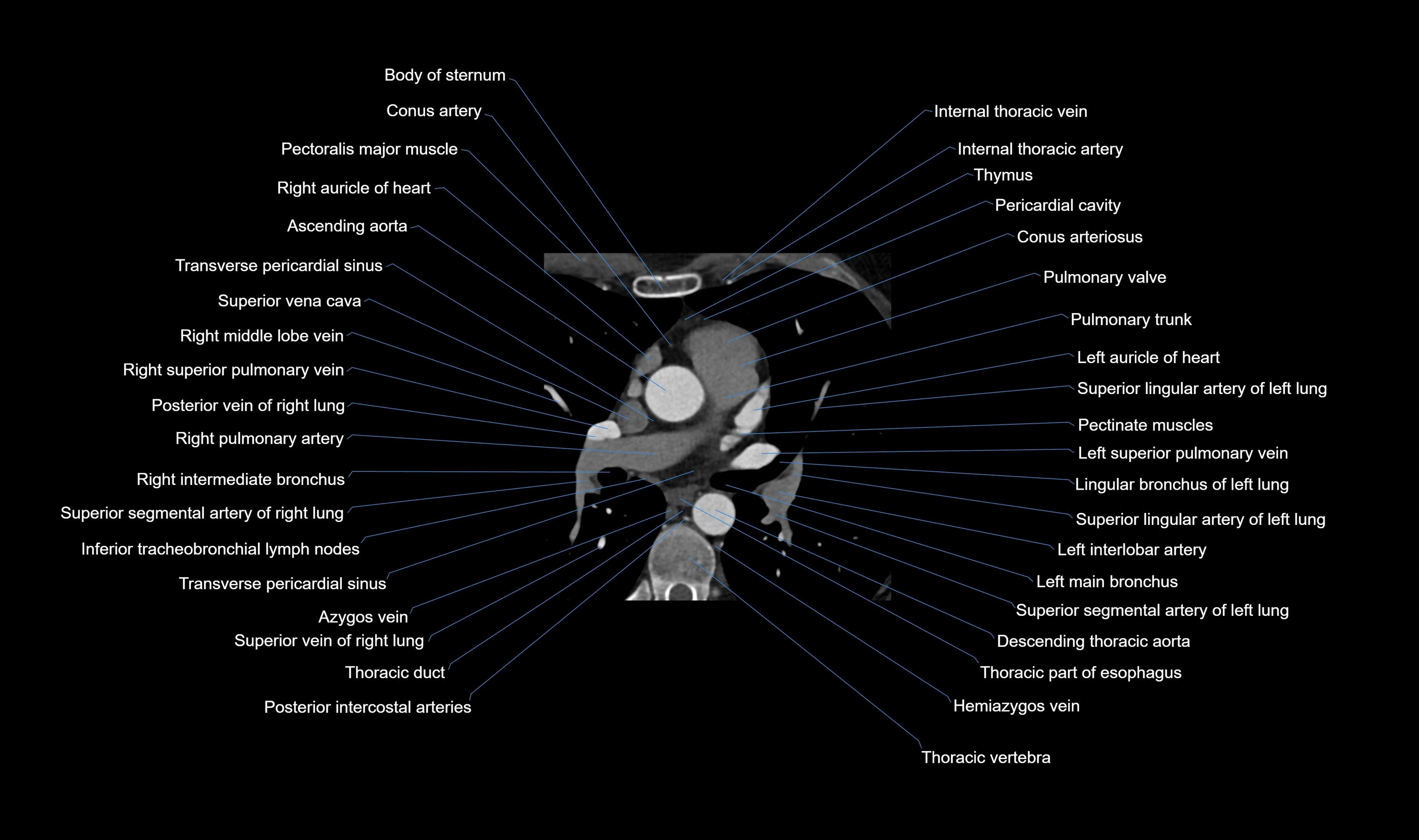 CT heart (coronary angiogram) axial view cross sectional anatomy labelled radiology image-00018.webp